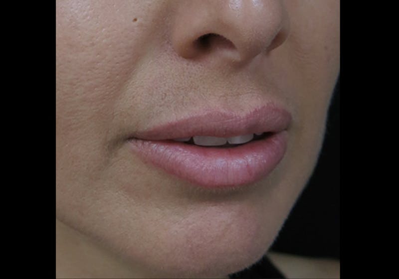 Lip Augmentation Before & After Gallery - Patient 122909241 - Image 4