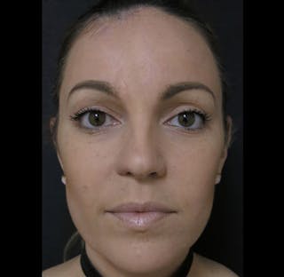 Nasal Reconstruction Before & After Gallery - Patient 122909242 - Image 4
