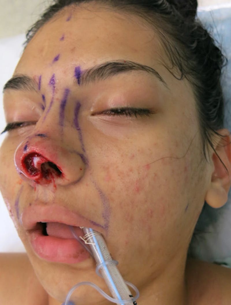 Laceration Repair Before & After Gallery - Patient 122909244 - Image 5
