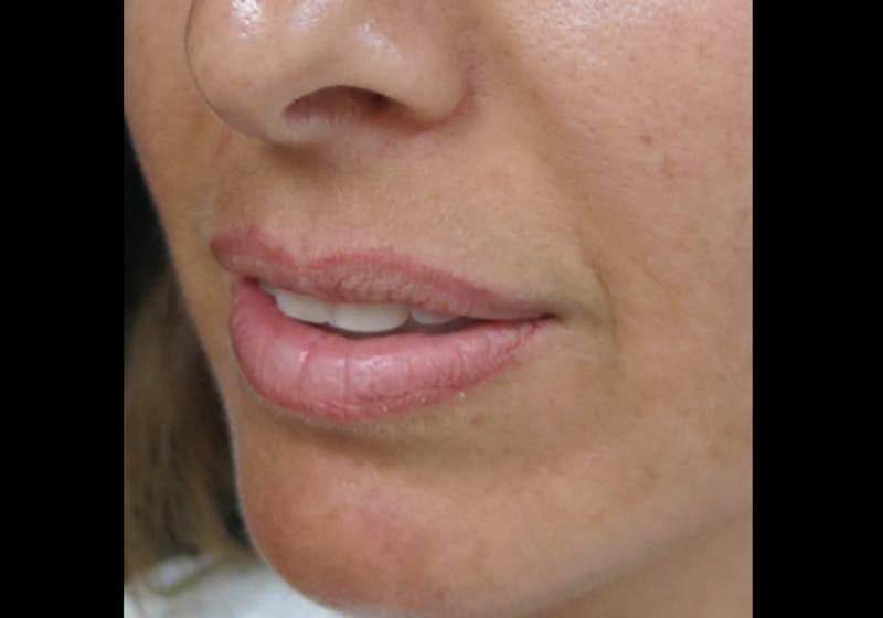 Lip Augmentation Before & After Gallery - Patient 122909241 - Image 5