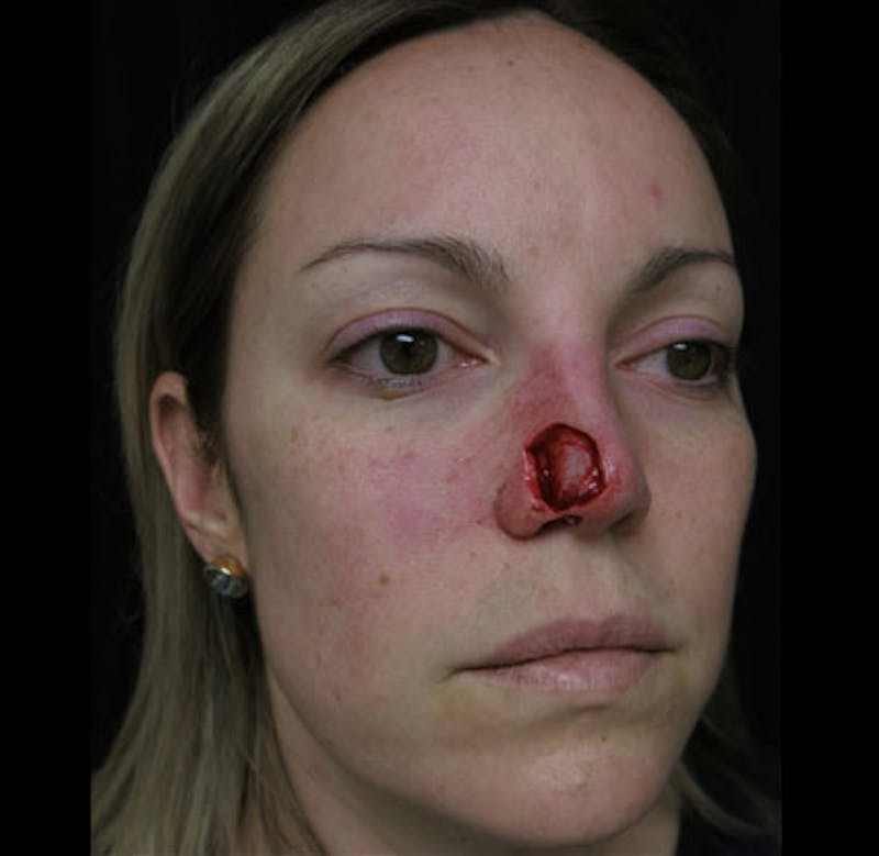 Nasal Reconstruction Before & After Gallery - Patient 122909242 - Image 5