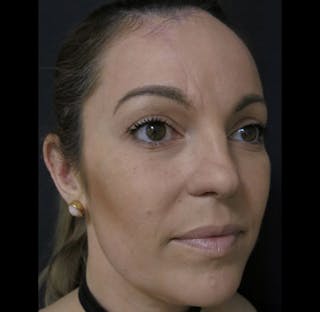 Nasal Reconstruction Before & After Gallery - Patient 122909242 - Image 6