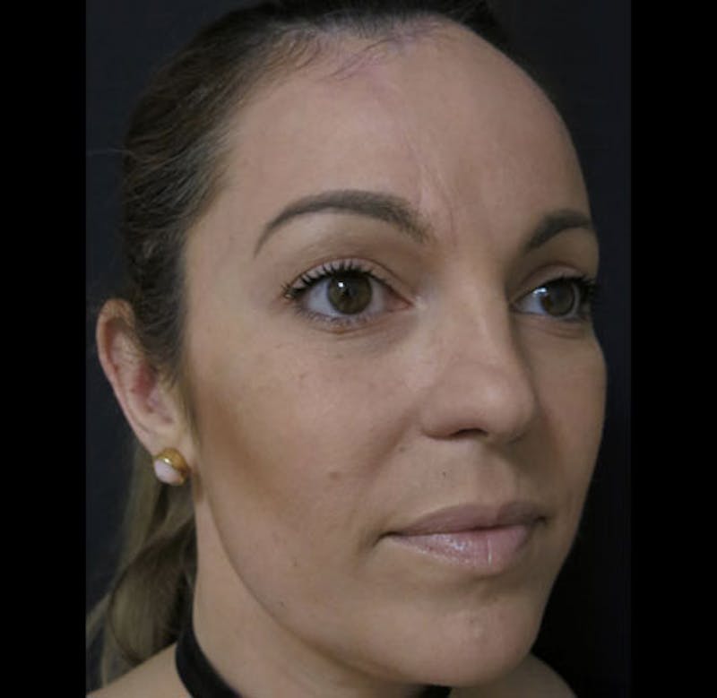 Nasal Reconstruction Before & After Gallery - Patient 122909242 - Image 6