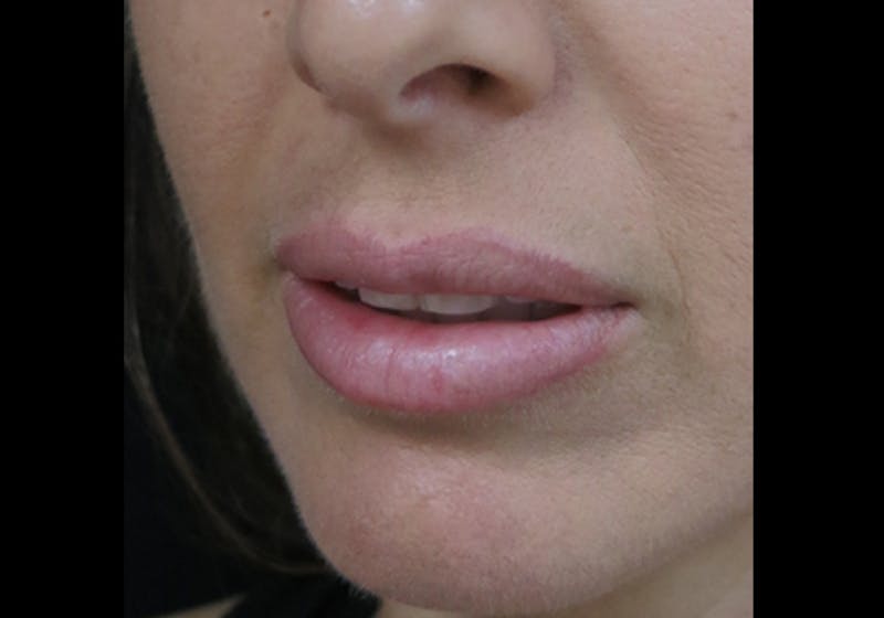 Lip Augmentation Before & After Gallery - Patient 122909241 - Image 6