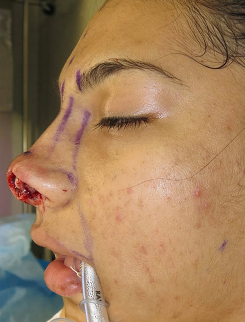 Laceration Repair Before & After Gallery - Patient 122909244 - Image 7