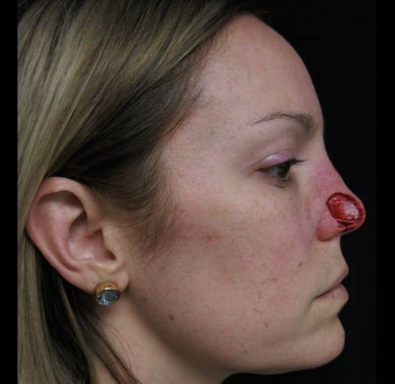 Nasal Reconstruction Before & After Gallery - Patient 122909242 - Image 7