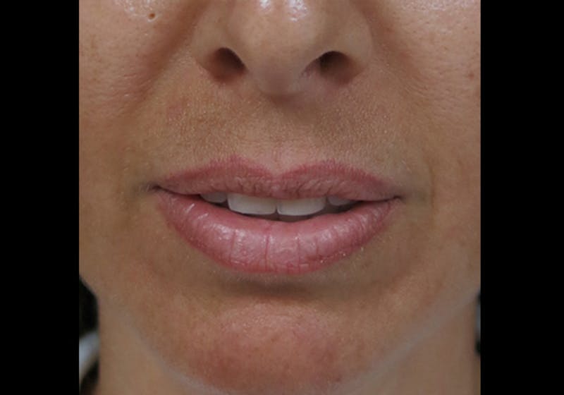 Lip Augmentation Before & After Gallery - Patient 122909241 - Image 7