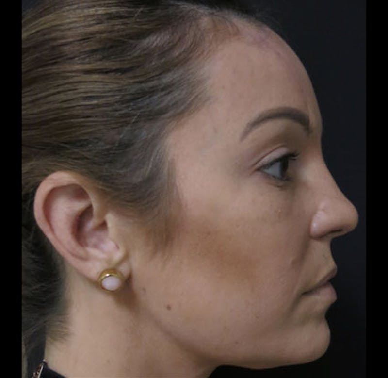 Nasal Reconstruction Before & After Gallery - Patient 122909242 - Image 8