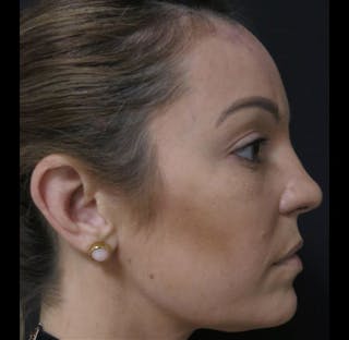 Nasal Reconstruction Before & After Gallery - Patient 122909242 - Image 8