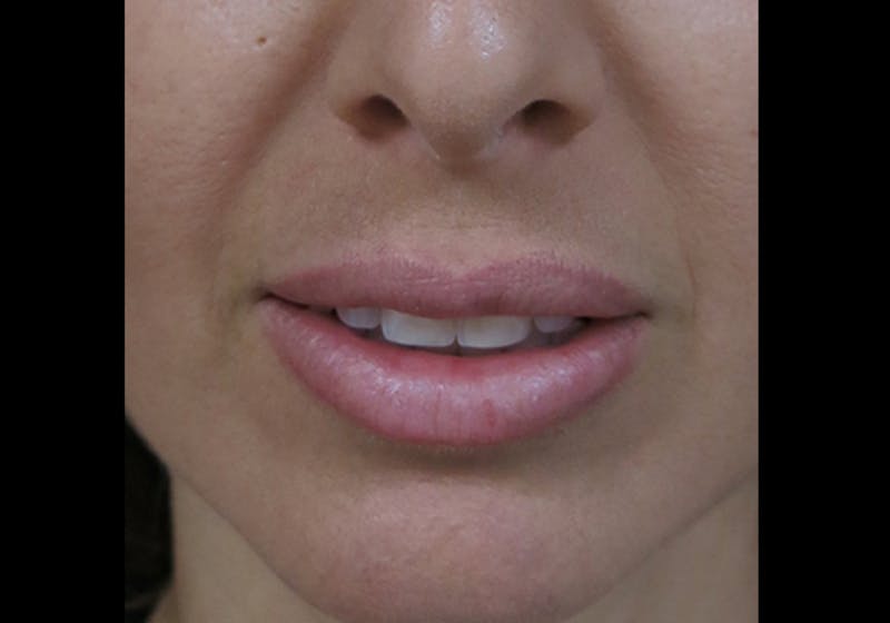 Lip Augmentation Before & After Gallery - Patient 122909241 - Image 8