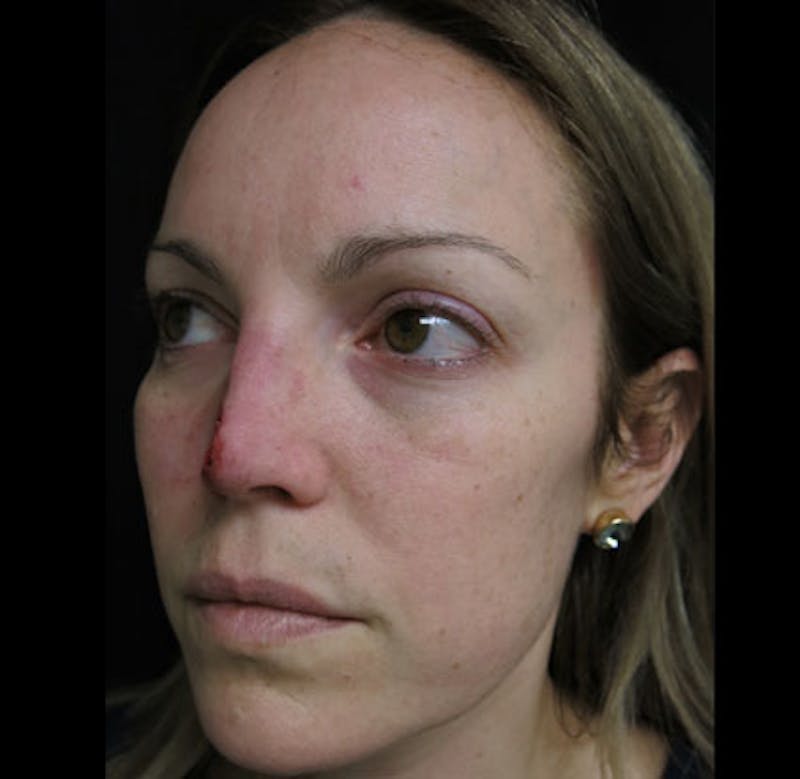 Nasal Reconstruction Before & After Gallery - Patient 122909242 - Image 9