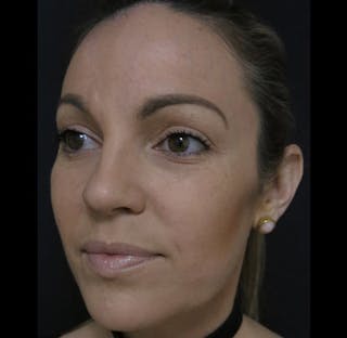 Nasal Reconstruction Before & After Gallery - Patient 122909242 - Image 10