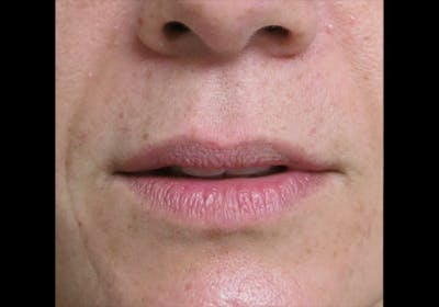 Lip Augmentation Before & After Gallery - Patient 122909245 - Image 1