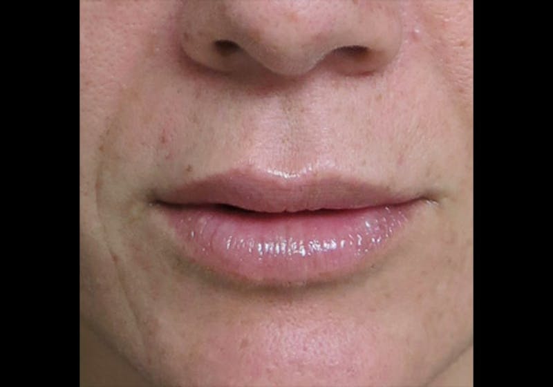 Lip Augmentation Before & After Gallery - Patient 122909245 - Image 2