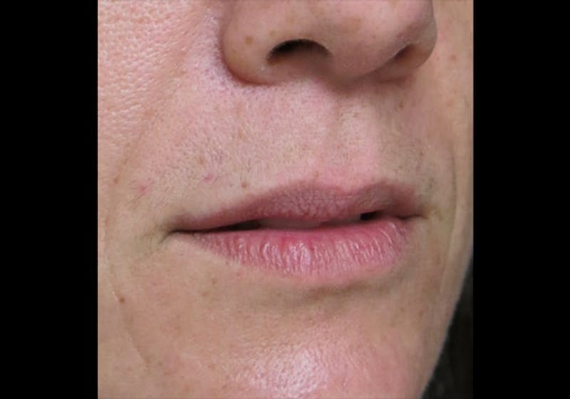 Lip Augmentation Before & After Gallery - Patient 122909245 - Image 3