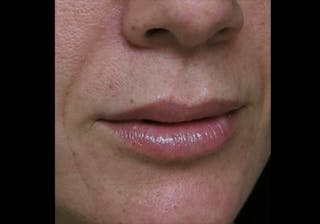 Lip Augmentation Before & After Gallery - Patient 122909245 - Image 4