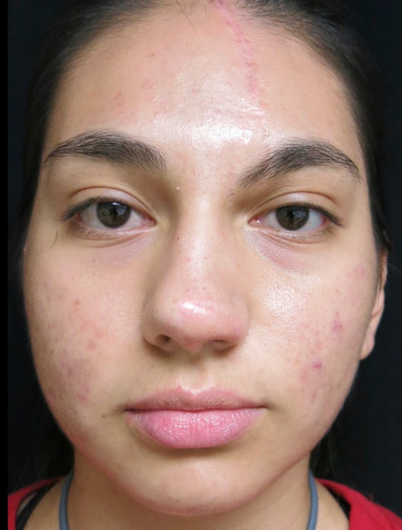 Nasal Reconstruction Before & After Gallery - Patient 122909248 - Image 2