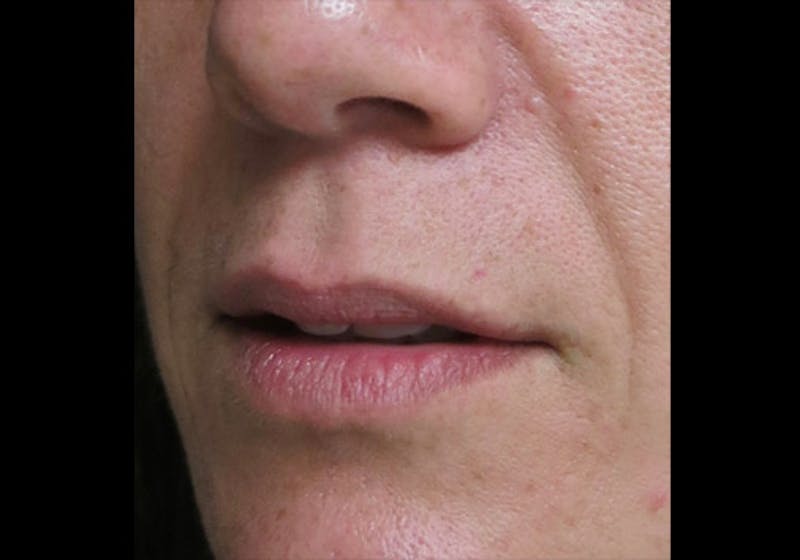 Lip Augmentation Before & After Gallery - Patient 122909245 - Image 5