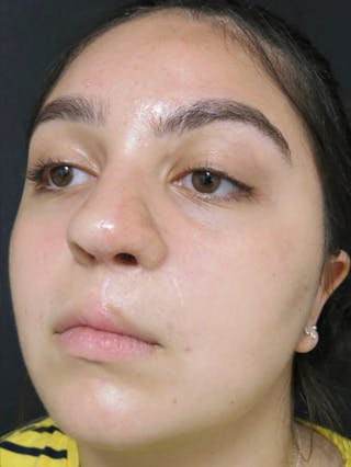Laceration Repair Before & After Gallery - Patient 122909247 - Image 2