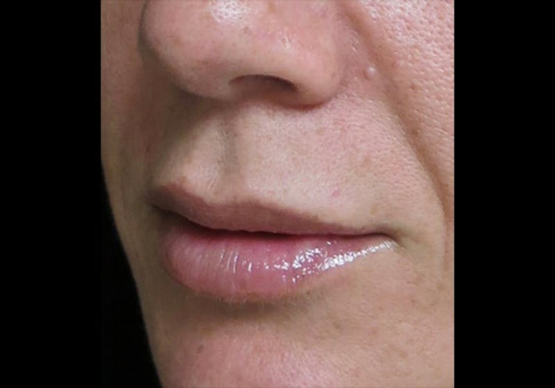Lip Augmentation Before & After Gallery - Patient 122909245 - Image 6