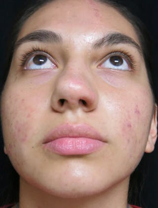 Nasal Reconstruction Before & After Gallery - Patient 122909248 - Image 4
