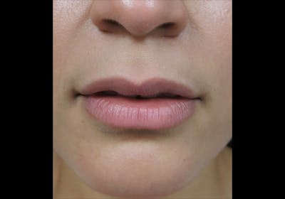 Lip Augmentation Before & After Gallery - Patient 122909246 - Image 1