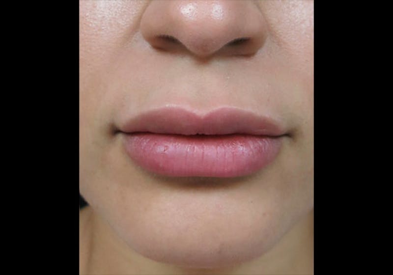 Lip Augmentation Before & After Gallery - Patient 122909246 - Image 2