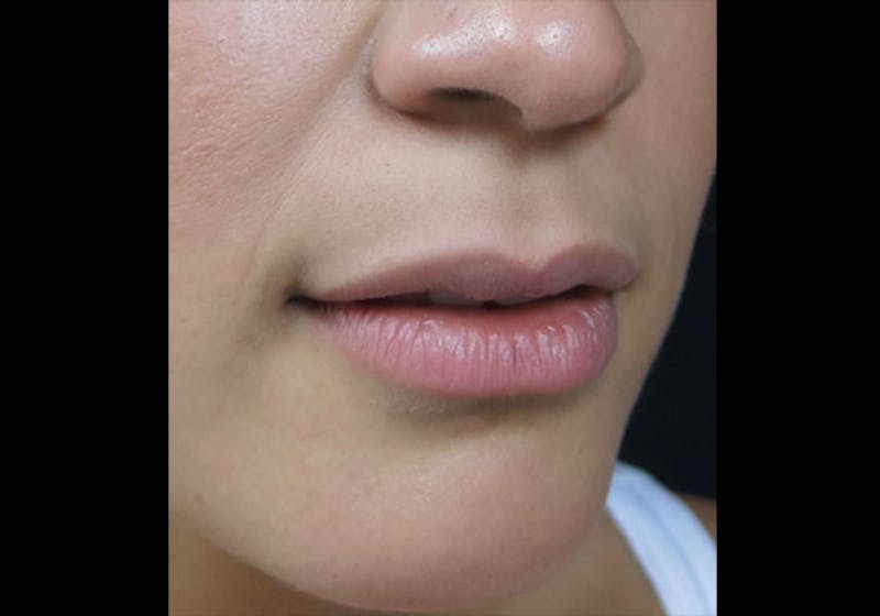 Lip Augmentation Before & After Gallery - Patient 122909246 - Image 3