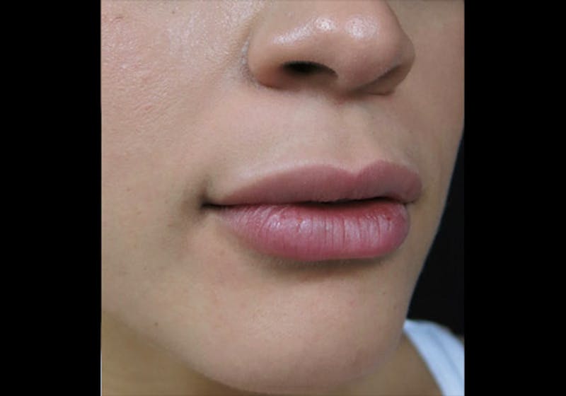 Lip Augmentation Before & After Gallery - Patient 122909246 - Image 4