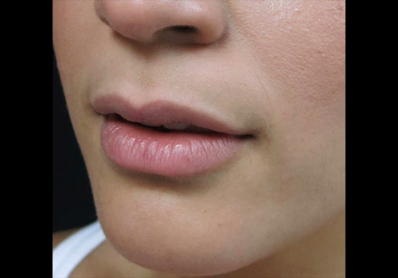 Lip Augmentation Before & After Gallery - Patient 122909246 - Image 5