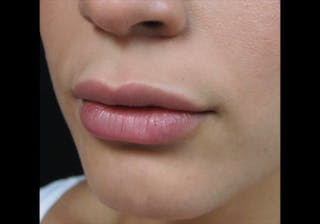 Lip Augmentation Before & After Gallery - Patient 122909246 - Image 6