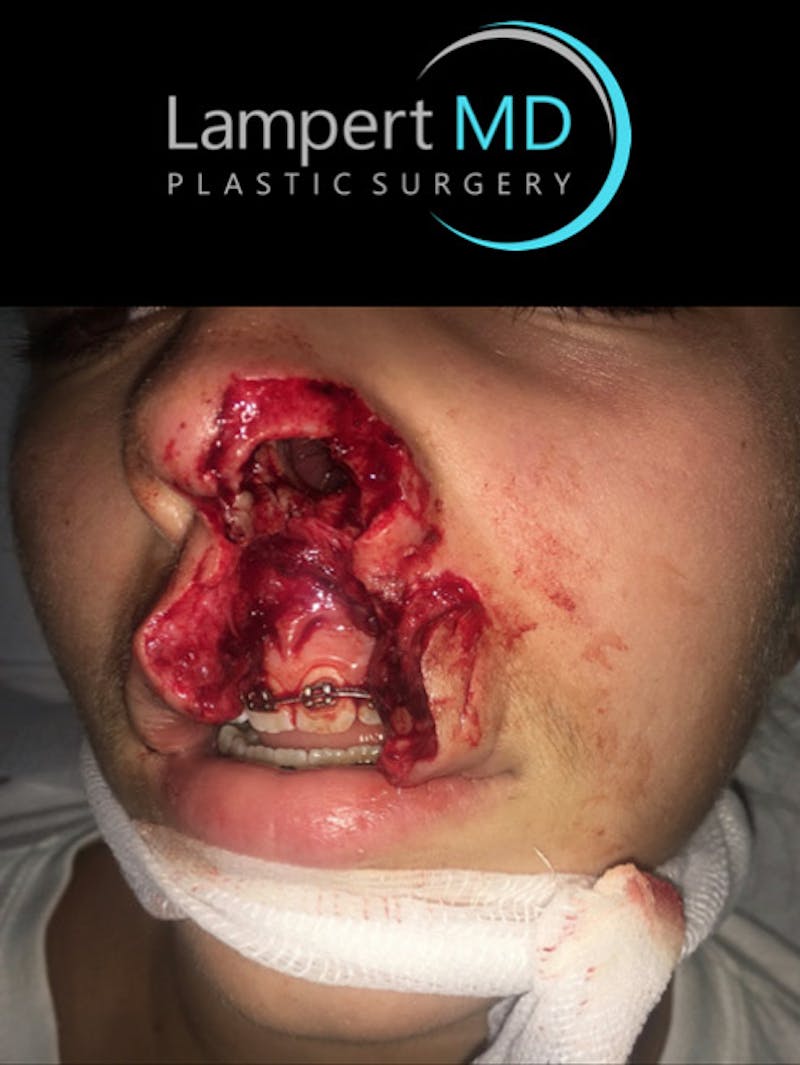 Laceration Repair Before & After Gallery - Patient 122909247 - Image 9