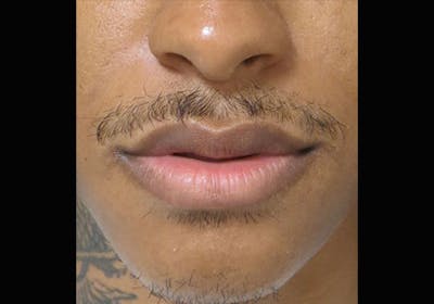 Lip Augmentation Before & After Gallery - Patient 122909251 - Image 1