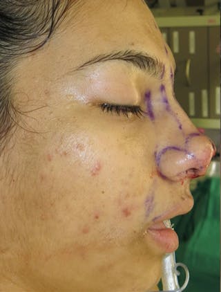 Nasal Reconstruction Before & After Gallery - Patient 122909248 - Image 12