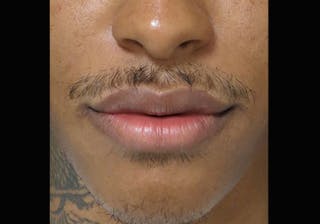 Lip Augmentation Before & After Gallery - Patient 122909251 - Image 2
