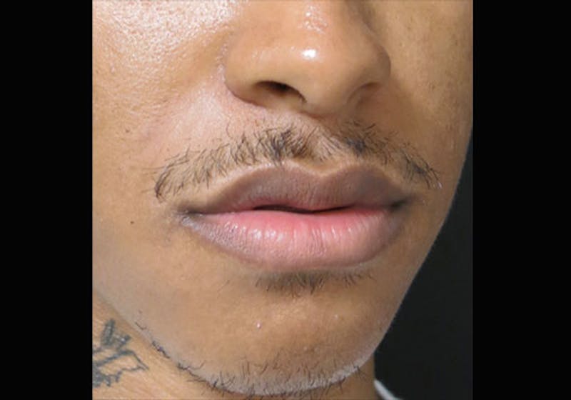 Lip Augmentation Before & After Gallery - Patient 122909251 - Image 3