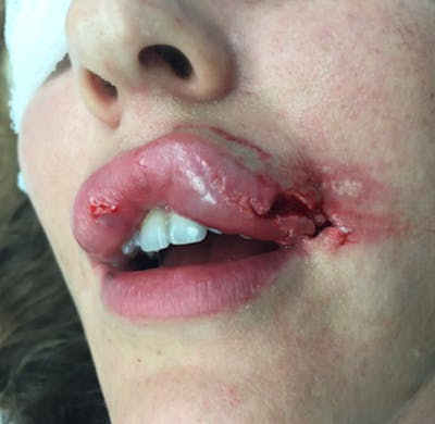 Laceration Repair Before & After Gallery - Patient 122909249 - Image 1