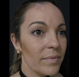 Skin Cancer Reconstruction Before & After Gallery - Patient 122909252 - Image 6