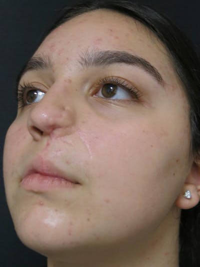 Nasal Reconstruction Before & After Gallery - Patient 122909260 - Image 1