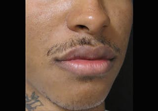 Lip Augmentation Before & After Gallery - Patient 122909251 - Image 4