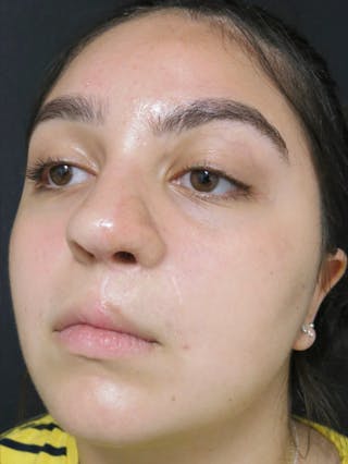 Nasal Reconstruction Before & After Gallery - Patient 122909260 - Image 2