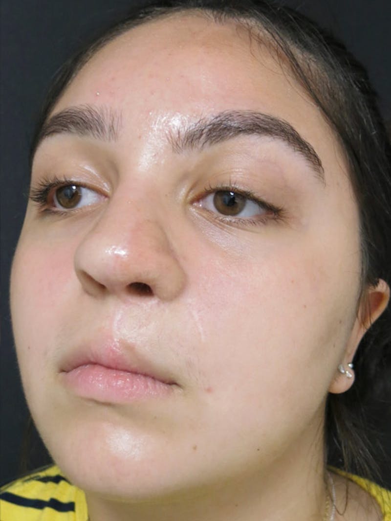 Nasal Reconstruction Before & After Gallery - Patient 122909260 - Image 2