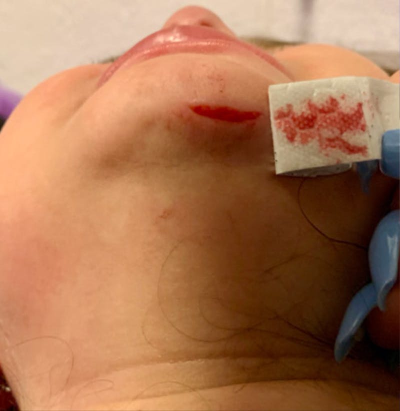 Laceration Repair Before & After Gallery - Patient 122909253 - Image 1