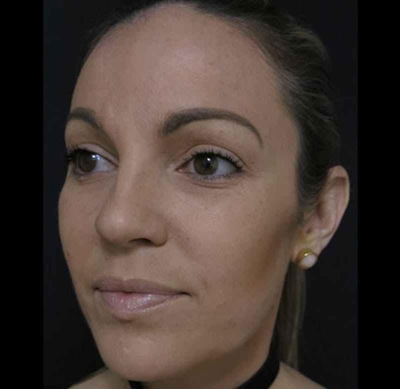 Skin Cancer Reconstruction Before & After Gallery - Patient 122909252 - Image 10