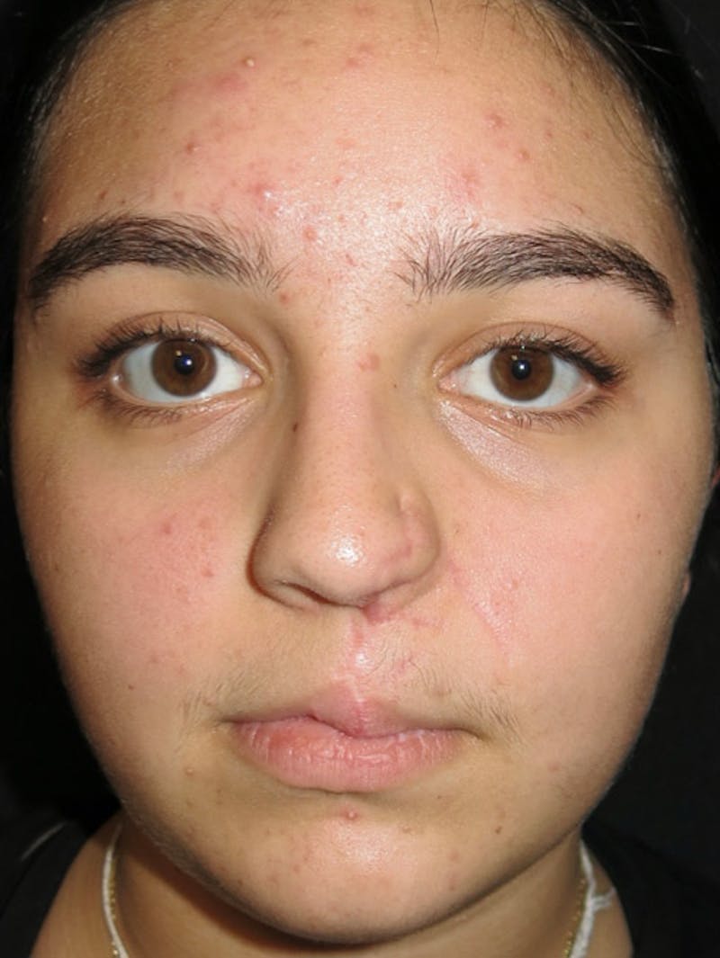 Nasal Reconstruction Before & After Gallery - Patient 122909260 - Image 5