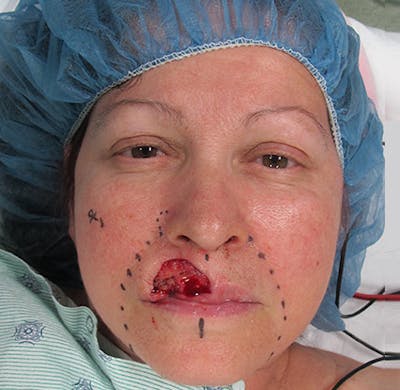 Skin Cancer Reconstruction Before & After Gallery - Patient 122909256 - Image 1