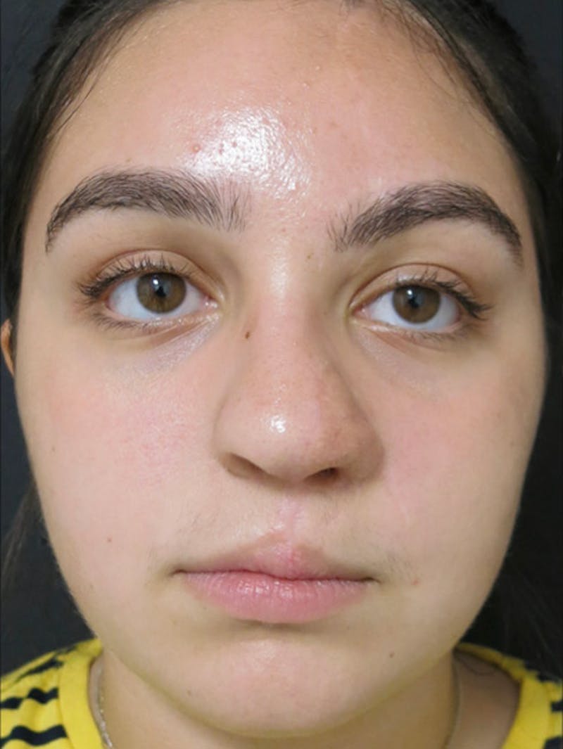 Nasal Reconstruction Before & After Gallery - Patient 122909260 - Image 6