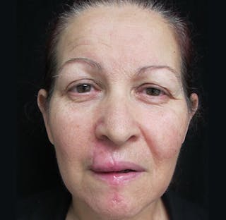 Skin Cancer Reconstruction Before & After Gallery - Patient 122909256 - Image 2