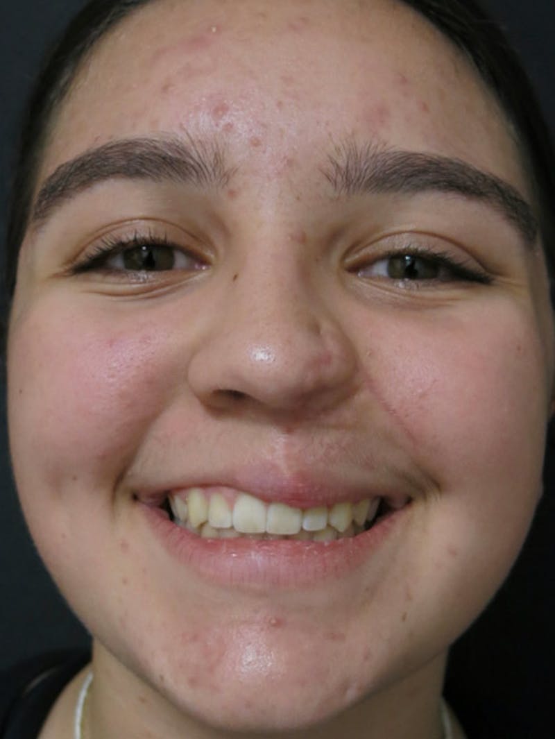 Nasal Reconstruction Before & After Gallery - Patient 122909260 - Image 7