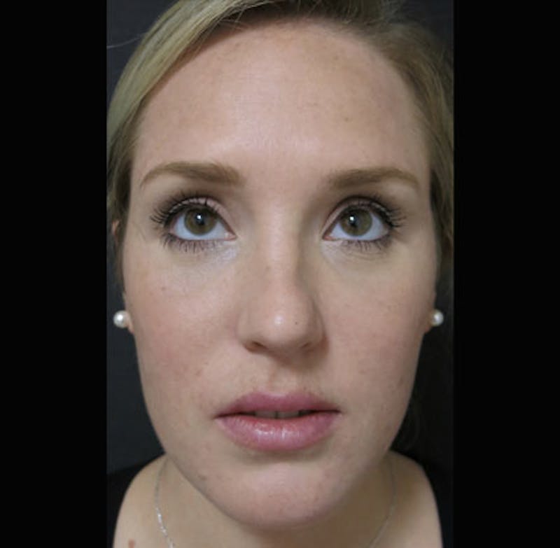 Lip Augmentation Before & After Gallery - Patient 298783 - Image 4